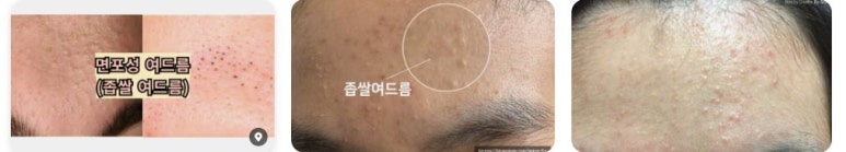[Dr. Bellview Column 72.] Acne: Don’t Worry Anymore! Causes and Solutions by Type image 7