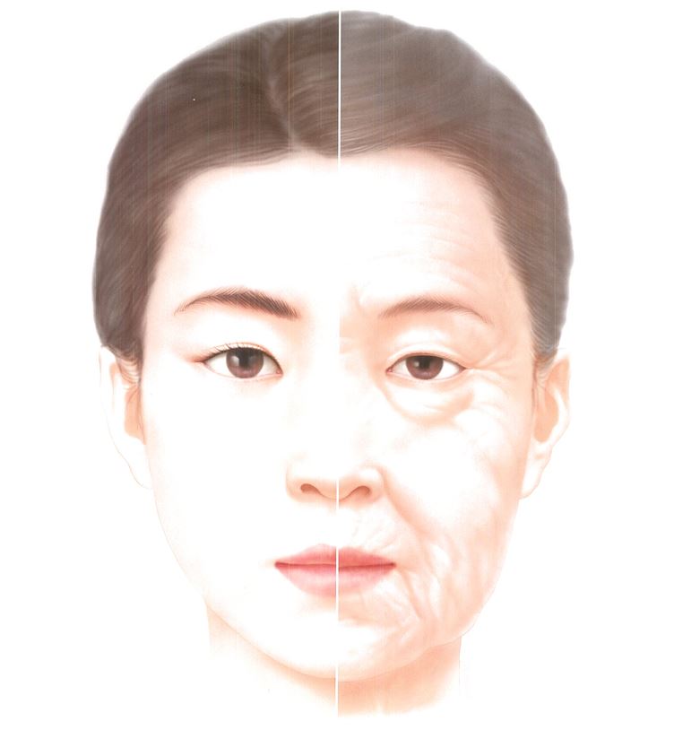 [닥터벨뷰 칼럼 62.] 쥬베룩은 안티에이징 시술의 꽃 관련 이미지 9