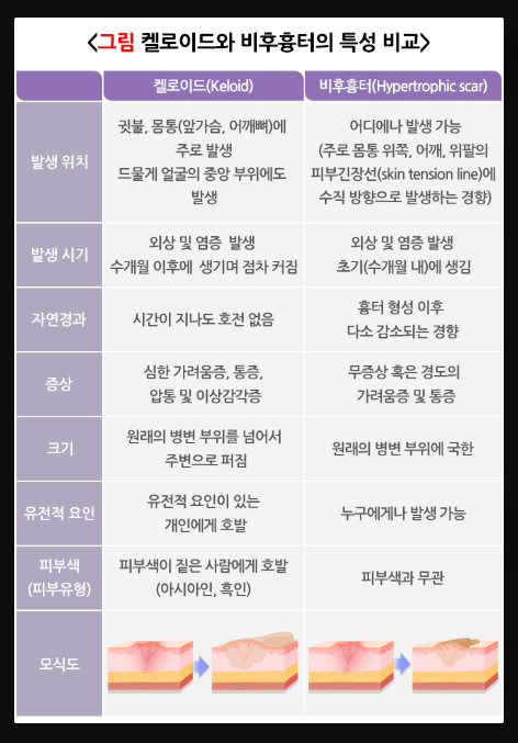 켈로이드 가족력 유전되는 이유와 비후성 흉터 비교 관련 이미지 10