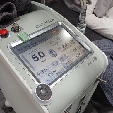 Bellvue Clinic Excel V Laser Treatment A to Z image 5