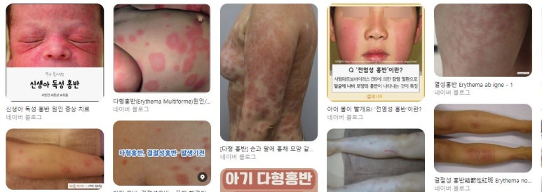 피부과 시술 후 멍이 심하게 들었다? 나는 왜 멍이 잘 들까? 관련 이미지 4