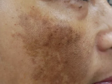 [Dr. Bellvue Column 59.] The Solution to Winter Pores, Pigmentation, and Elasticity Concerns: ‘Genesis Toning’ image 5