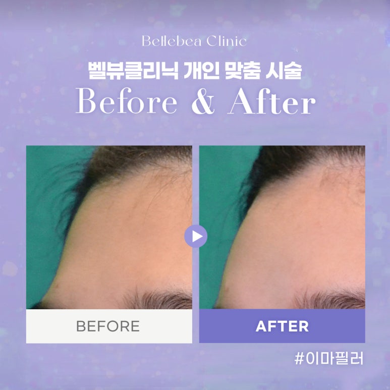 29. 벨뷰클리닉 이마필러 전후사진 관련 이미지 1