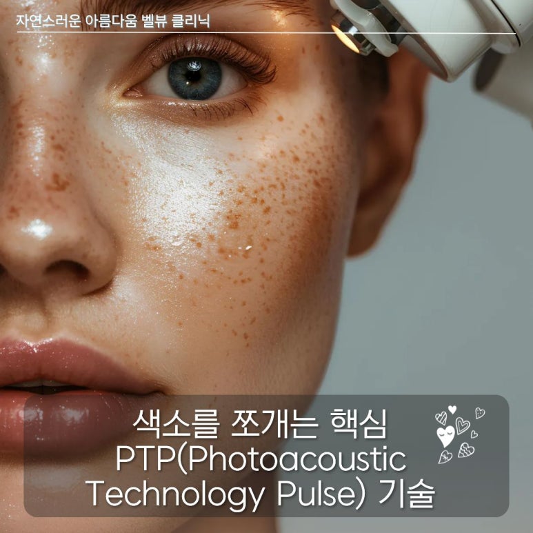 색소 많은데 왜 레블라이트 안 하세요?안 하면 손해!!! 관련 이미지 2