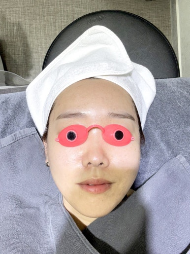 팔자주름 필러만으로 부족하다면? 4가지 관련 이미지 5