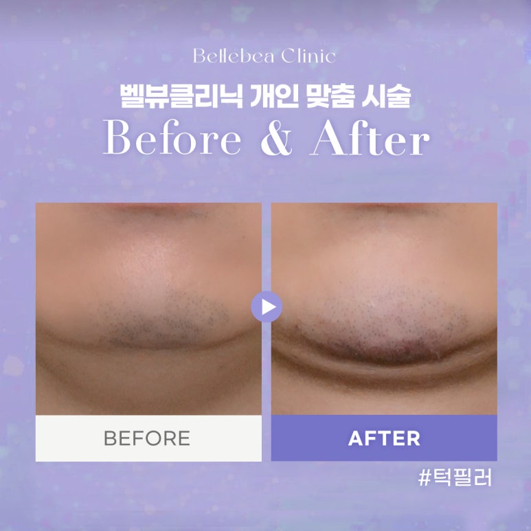 강남역피부과 턱필러전후사진 턱필러후기 관련 이미지 1