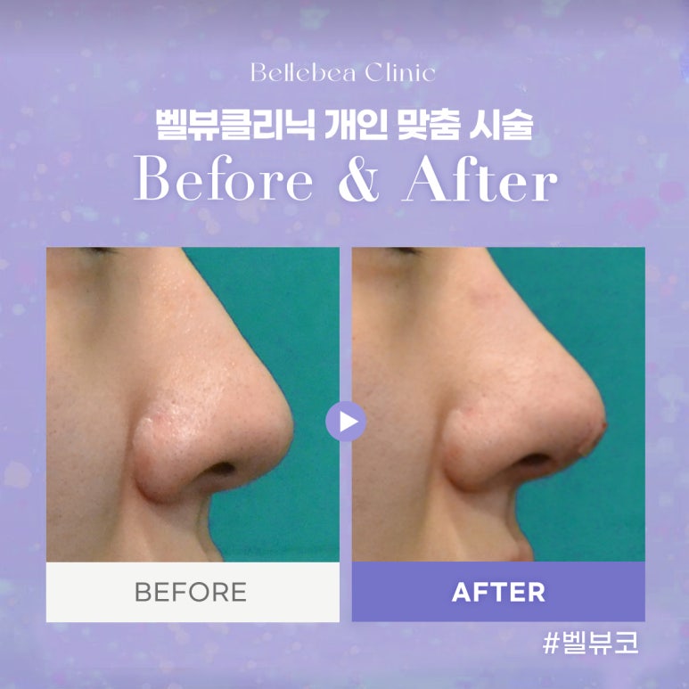벨뷰클리닉 개인 맞춤 시술 관련 이미지 1