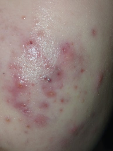 [Dr. Bellview Column 72.] Acne: Don’t Worry Anymore! Causes and Solutions by Type image 4