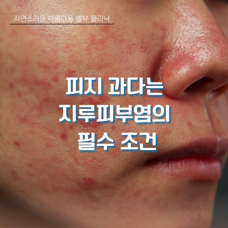 [Dr. Bellevue Column 106.] Oily on the Outside, Dry on the Inside? Get Seborrheic Dermatitis Under Control with This image 3