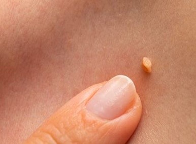 [Dr. Belleview Column 74.] Why You Shouldn’t Leave Skin Tags on Your Neck Alone image 3