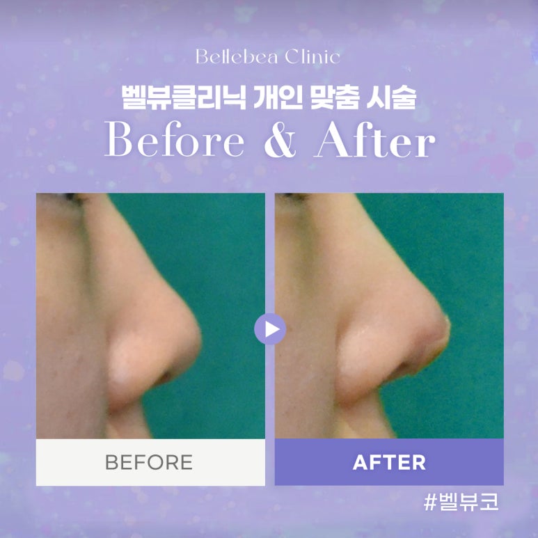 벨뷰클리닉 개인맞춤시술 관련 이미지 1