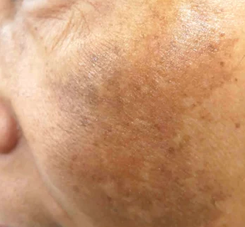 피부과 시술 중 색소는 왜 꼭 초기에 치료하라고 할까? 관련 이미지 6