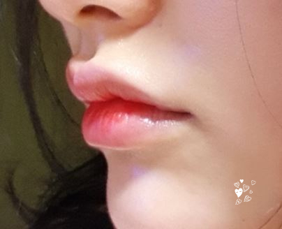 입술과 입가 미세 주름을 위한 부드러운 필러는? 리쥬비엘 W 관련 이미지 7