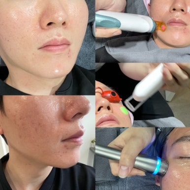 쌩얼도 예뻐지고 싶다면? 꿀피부 만드는 3가지 시술! 관련 이미지 5