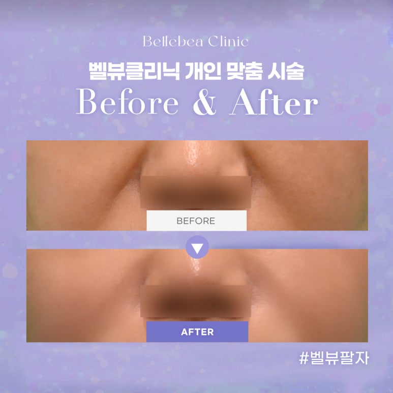 38. 벨뷰클리닉 팔자필러 전후사진 관련 이미지 1