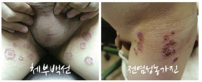 동전모양습진, 화폐상습진(Nummular eczema) 알아보기 관련 이미지 6