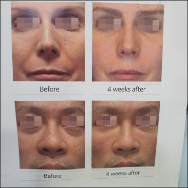 [Dr. Bellview Column 90.] Luxury Skin Completed by a Hair’s Breadth of Difference: Why the Dosage of Skin Boosters Determines the Details of the Result image 6