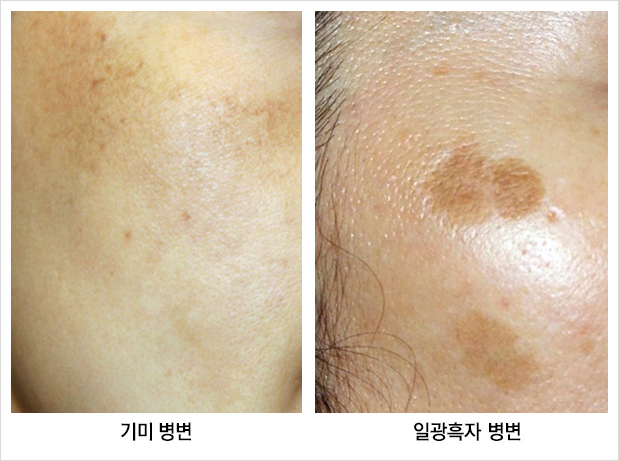 피부과 시술 중 색소는 왜 꼭 초기에 치료하라고 할까? 관련 이미지 2