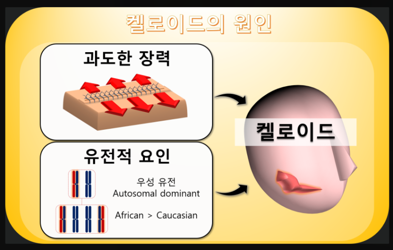 켈로이드 가족력 유전되는 이유와 비후성 흉터 비교 관련 이미지 3