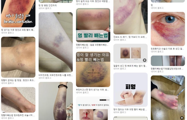 피부과 시술 후 멍이 심하게 들었다? 나는 왜 멍이 잘 들까? 관련 이미지 5