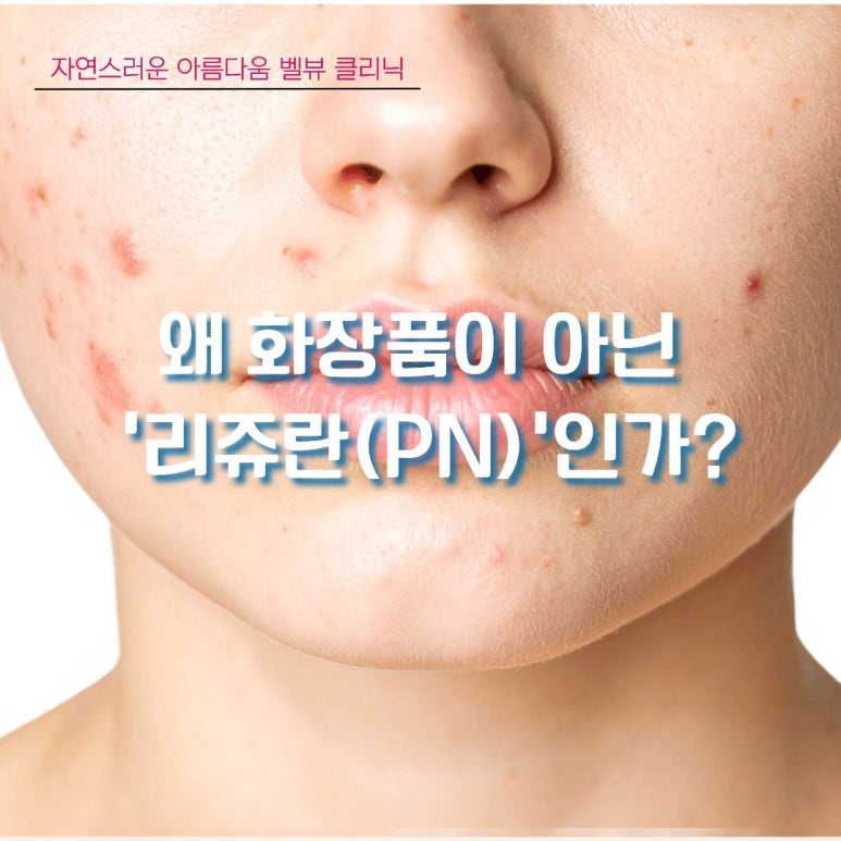 [Dr. Bellevue Column 106.] Oily on the Outside, Dry on the Inside? Get Seborrheic Dermatitis Under Control with This image 4