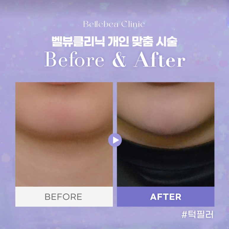 15. 강남역피부과 무턱필러전후사진 무턱필러후기 관련 이미지 1