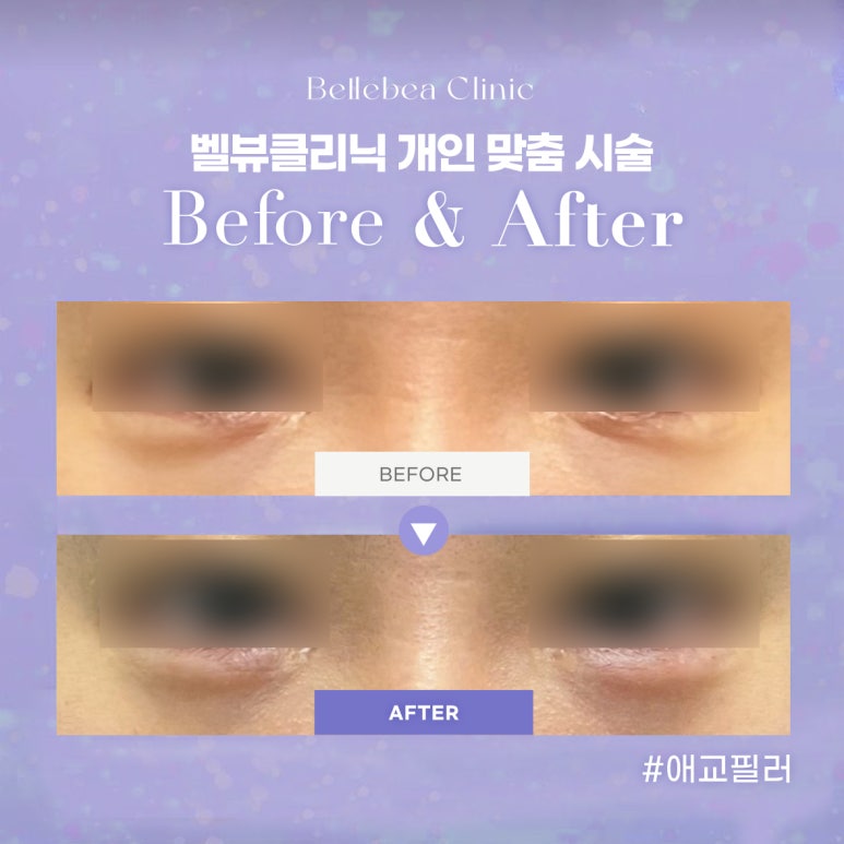 36. 벨뷰클리닉 애교필러 전후사진 관련 이미지 1