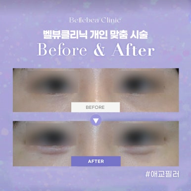 [닥터벨뷰 칼럼 62.] 쥬베룩은 안티에이징 시술의 꽃 관련 이미지 16