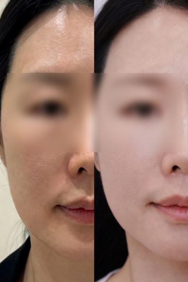 How to Achieve an Unedited Jawline and Radiant Skin in 4 Weeks Before Your Wedding image 3