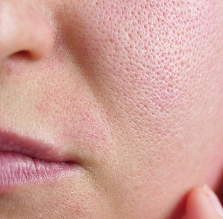 [Dr. Bellvue Column 59.] The Solution to Winter Pores, Pigmentation, and Elasticity Concerns: ‘Genesis Toning’ image 3