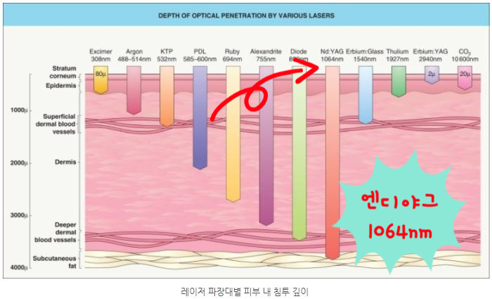 기미 치료는 레블라이트! 큐스위치 엔디야그 레이저 토닝 자신있는 민낯 완성해요 관련 이미지 5