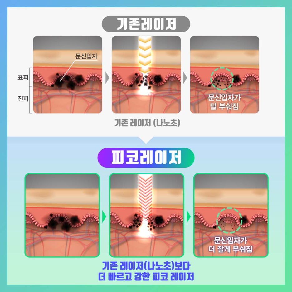 반영구눈썹문신 제거는 피코 레이저! 기미, 모공, 흉터 개선 효과까지 관련 이미지 6