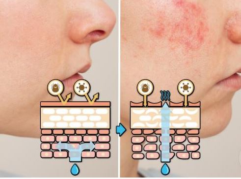 Oh no, is your skin barrier damaged? 3 Recommended Treatments for When Your Face Is Itchy, Stinging, and Red image 2
