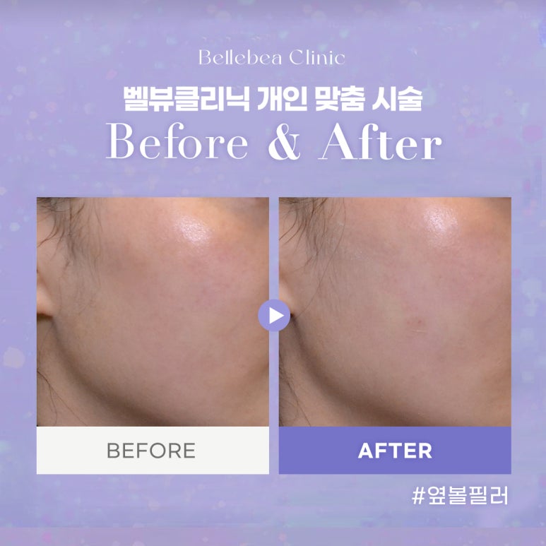 33. 벨뷰클리닉 옆볼필러 전후사진 관련 이미지 1