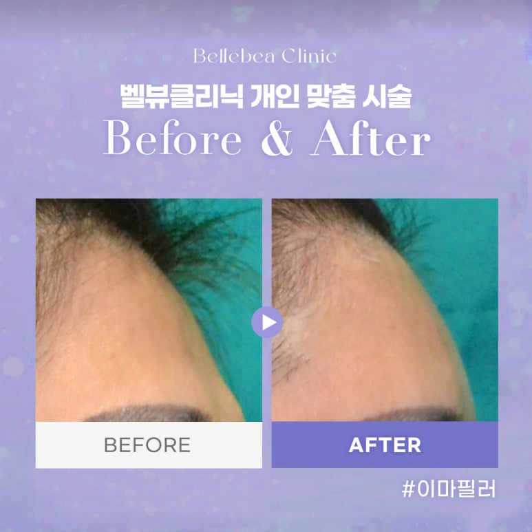 45. 벨뷰클리닉 이마필러 전후사진 관련 이미지 1