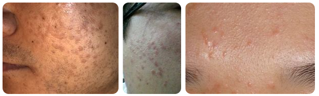 Smooth Skin with Laser Treatment for Flat Warts That Cause Skin Bumps image 4