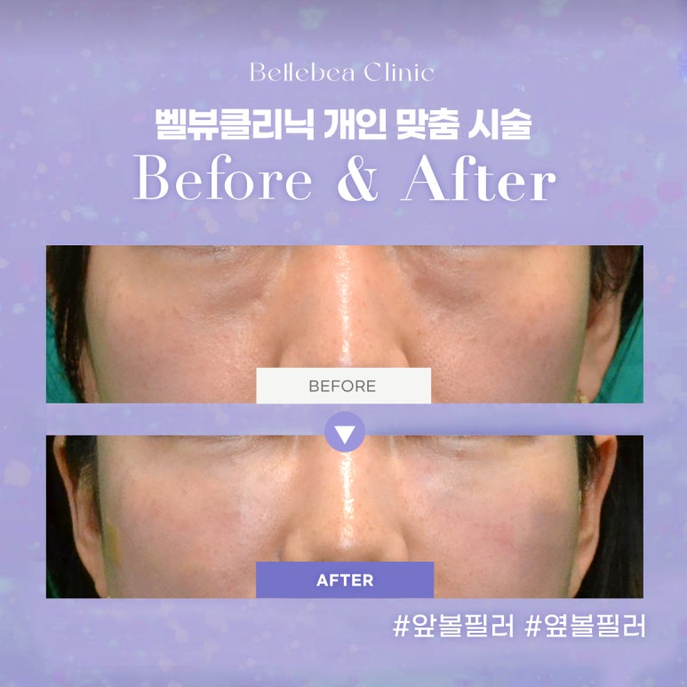 43. 벨뷰클리닉 앞볼필러 옆볼필러 전후사진 관련 이미지 1