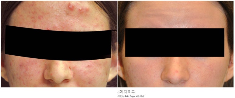 Bellvue Clinic Excel V Laser Treatment A to Z image 14