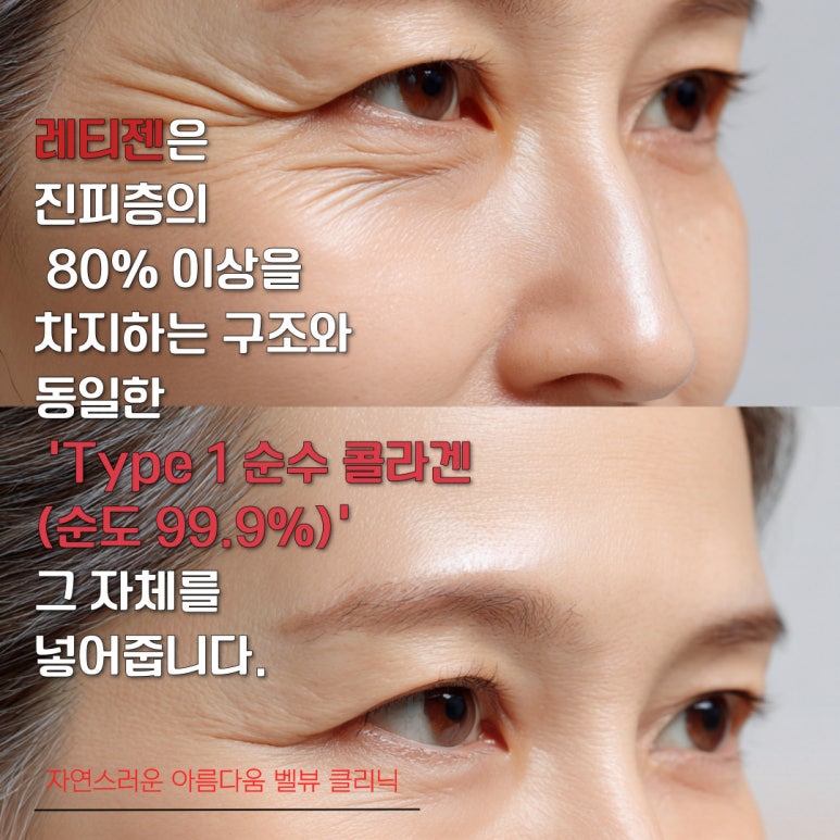 [닥터벨뷰 칼럼 103.] 리쥬란, 쥬베룩보다 비싼 &lsquo;레티젠&rsquo;, 정말 그 값을 할까? 관련 이미지 3