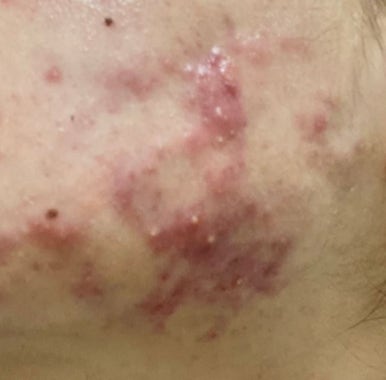 [Dr. Bellview Column 72.] Acne: Don’t Worry Anymore! Causes and Solutions by Type image 5