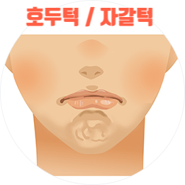 [닥터 벨뷰 칼럼 4.] 호두턱, 자갈턱 원인과 치료, 예방법 총정리 관련 이미지 4