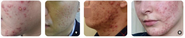 [Dr. Bellview Column 72.] Acne: Don’t Worry Anymore! Causes and Solutions by Type image 3