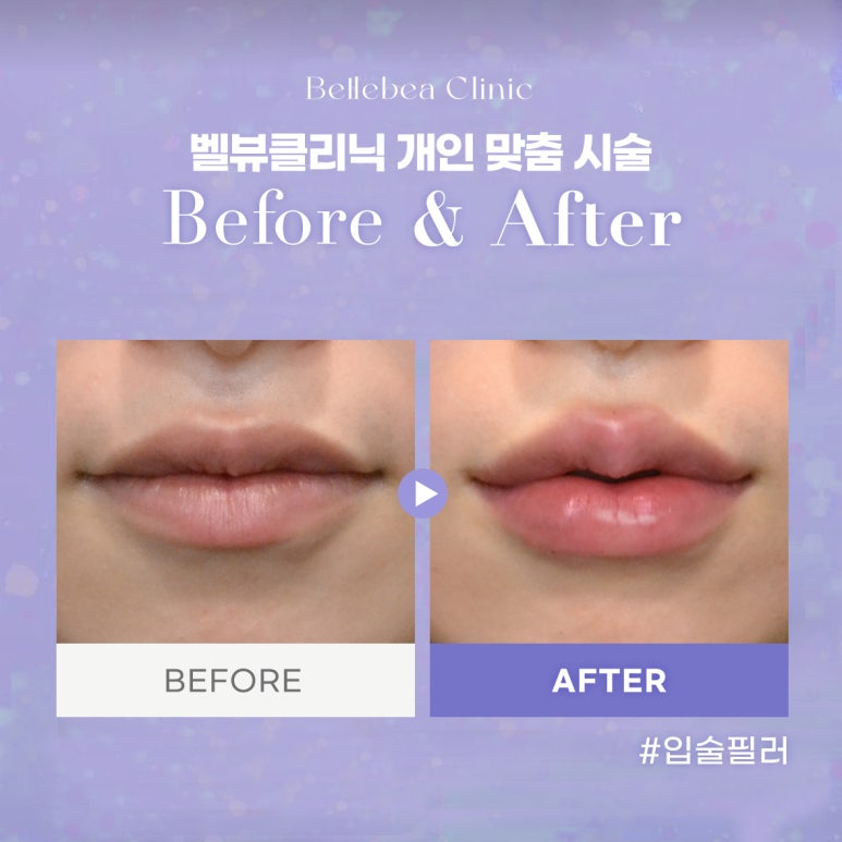 35. 벨뷰클리닉 입술필러 전후사진 관련 이미지 1