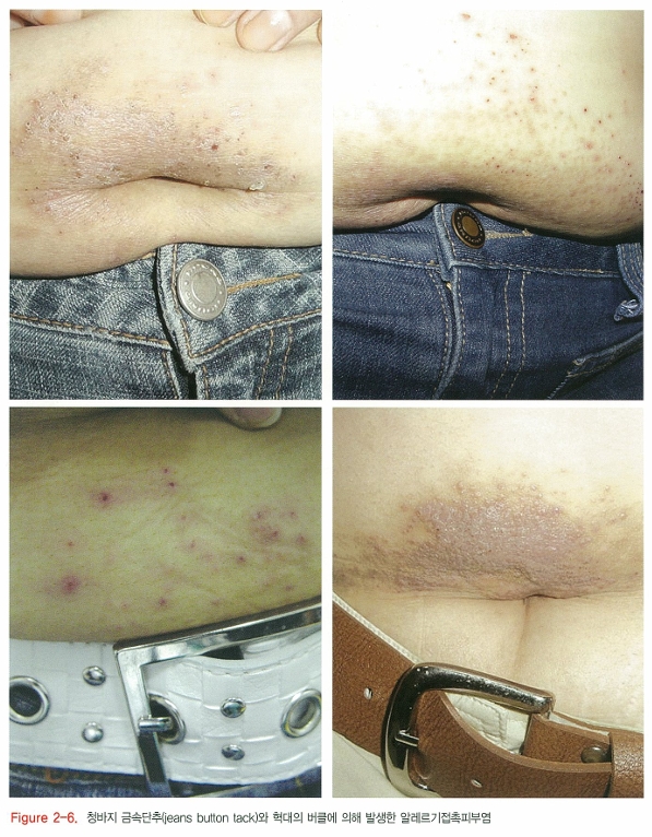 알레르기 접촉 피부염 / 자극 접촉 피부염 관련 이미지 6