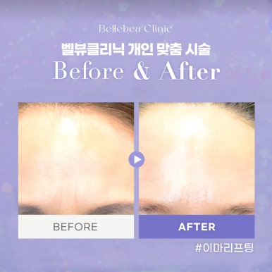 점심시간에 예뻐지는 비법! 벨뷰 퀵 시술 추천 관련 이미지 5