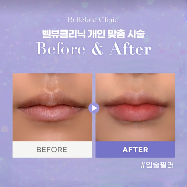 강남역피부과 입술필러전후사진 입술필러후기 관련 이미지 1