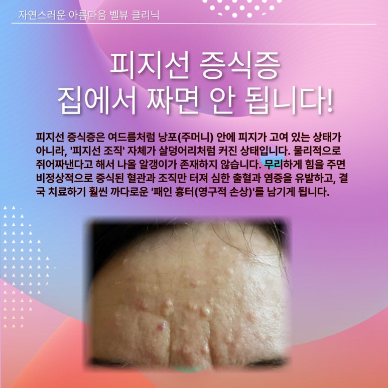 Bumps That Cannot Be Squeezed—Neither Skin Tags nor Acne: The Causes and Proper Treatment of ‘Sebaceous Hyperplasia’ image 6