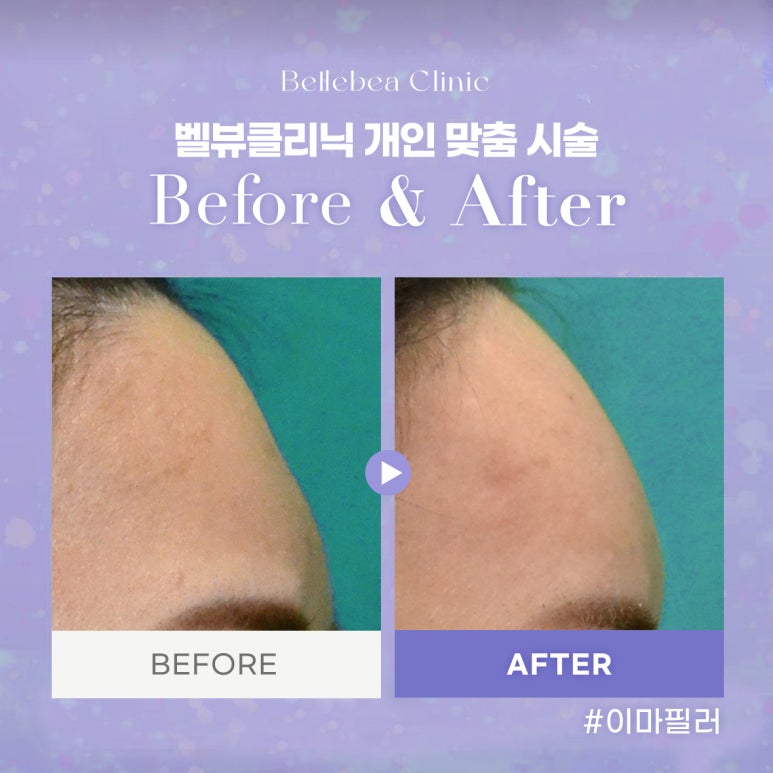 40. 벨뷰클리닉 이마필러 전후사진 관련 이미지 1