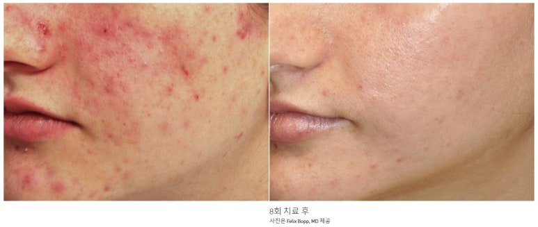 Bellvue Clinic Excel V Laser Treatment A to Z image 15
