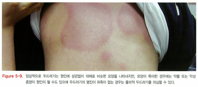 다양한 두드러기 종류 1탄 (알레르기성/ 만성특발성/ 한랭성/ 열성/ 피부묘기증 등) 관련 이미지 7